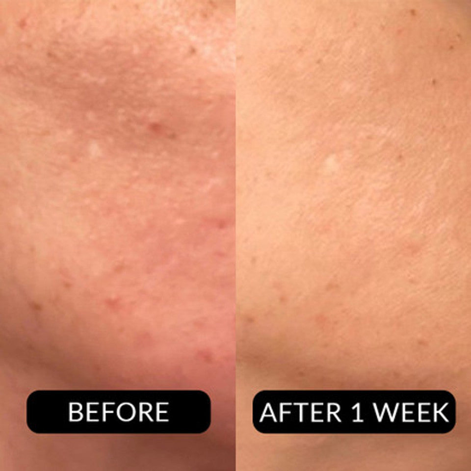 ProCorrective Clear-Control Mask